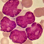 acute myeloid leukemia