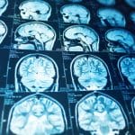 brain stroke