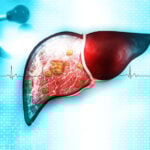 liver cancer