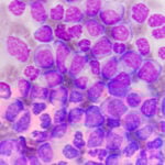 acute myeloid leukemia AML leukaemia